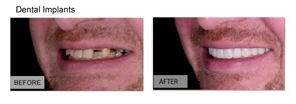 Dental implants before and after results — Huntington Beach patient, Dr. Richard Baldwin DMD