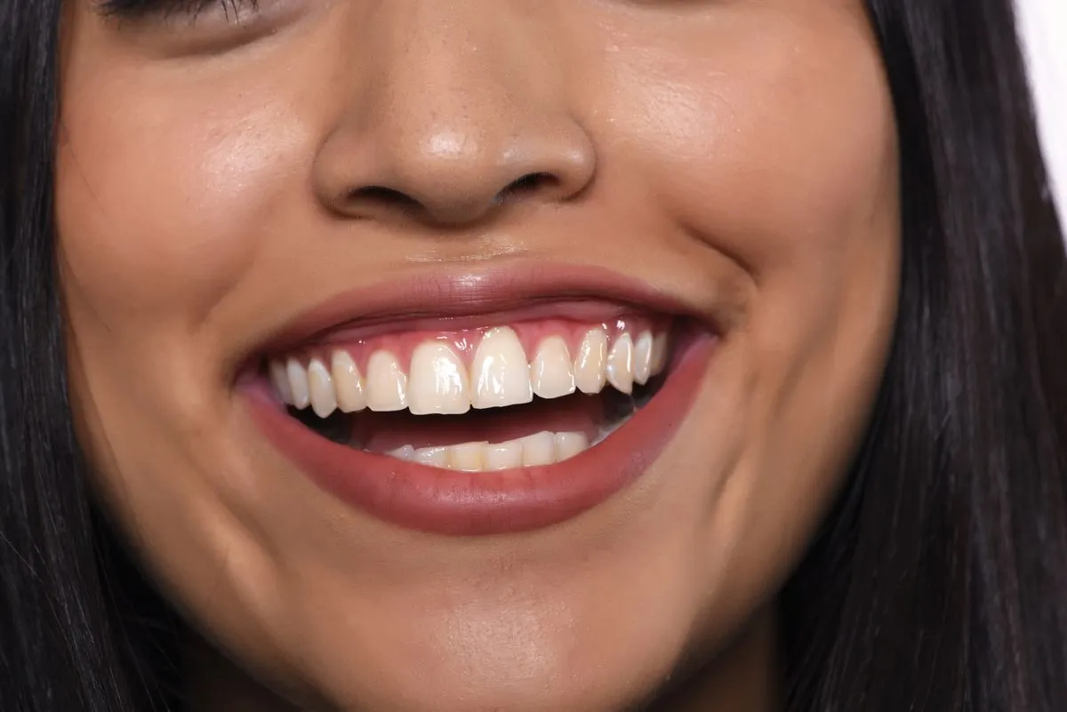 Lumineers before and after results — Huntington Beach patient, Dr. Richard Baldwin DMD