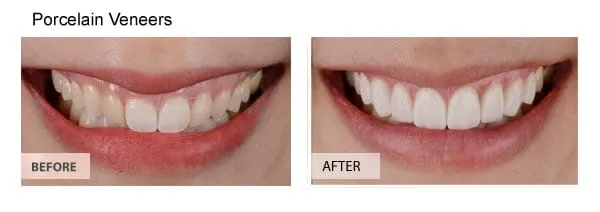 Porcelain veneers before and after results — Huntington Beach patient, Dr. Richard Baldwin DMD