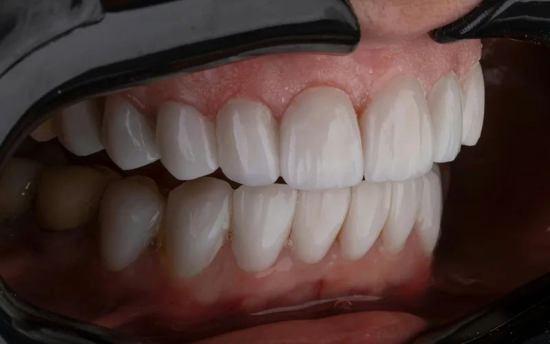 Close-up dental restoration on front tooth
