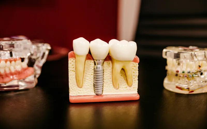 Dental implant model showing the titanium post, abutment, and crown compared to natural teeth