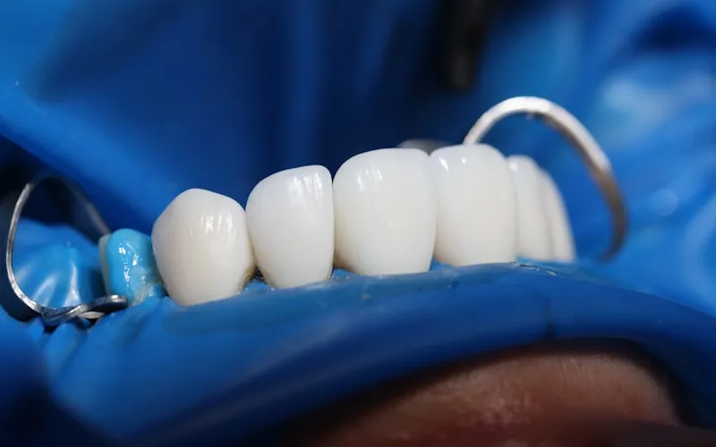 Close-up of porcelain veneers showing natural translucency and seamless fit