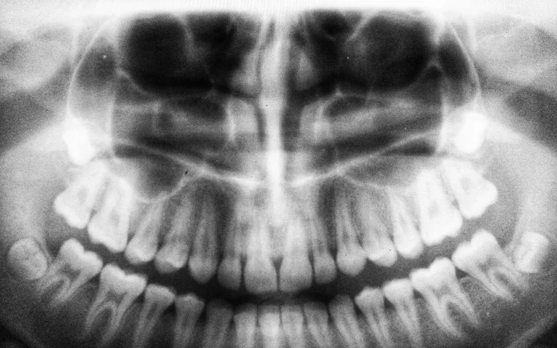 Panoramic dental X-ray showing impacted wisdom teeth requiring extraction