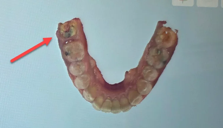 Top-down digital scan before treatment, with an arrow identifying the affected lower molar
