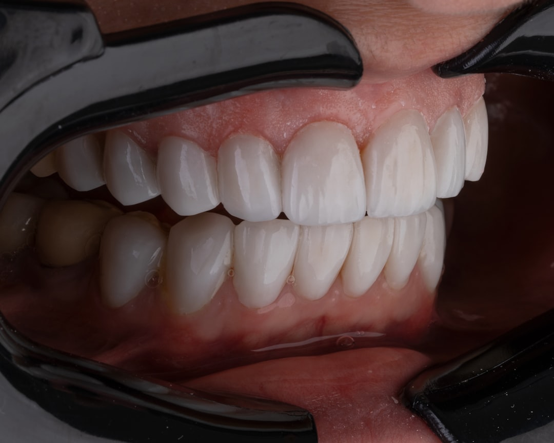 Veneers Cost Per Tooth in Huntington Beach: Real Tiers