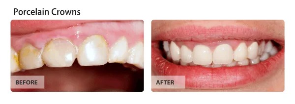 Dental crowns before and after results — Huntington Beach patient, Dr. Richard Baldwin DMD