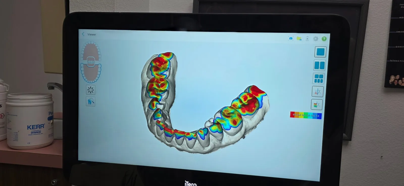 Digital smile design displayed on the office scanner