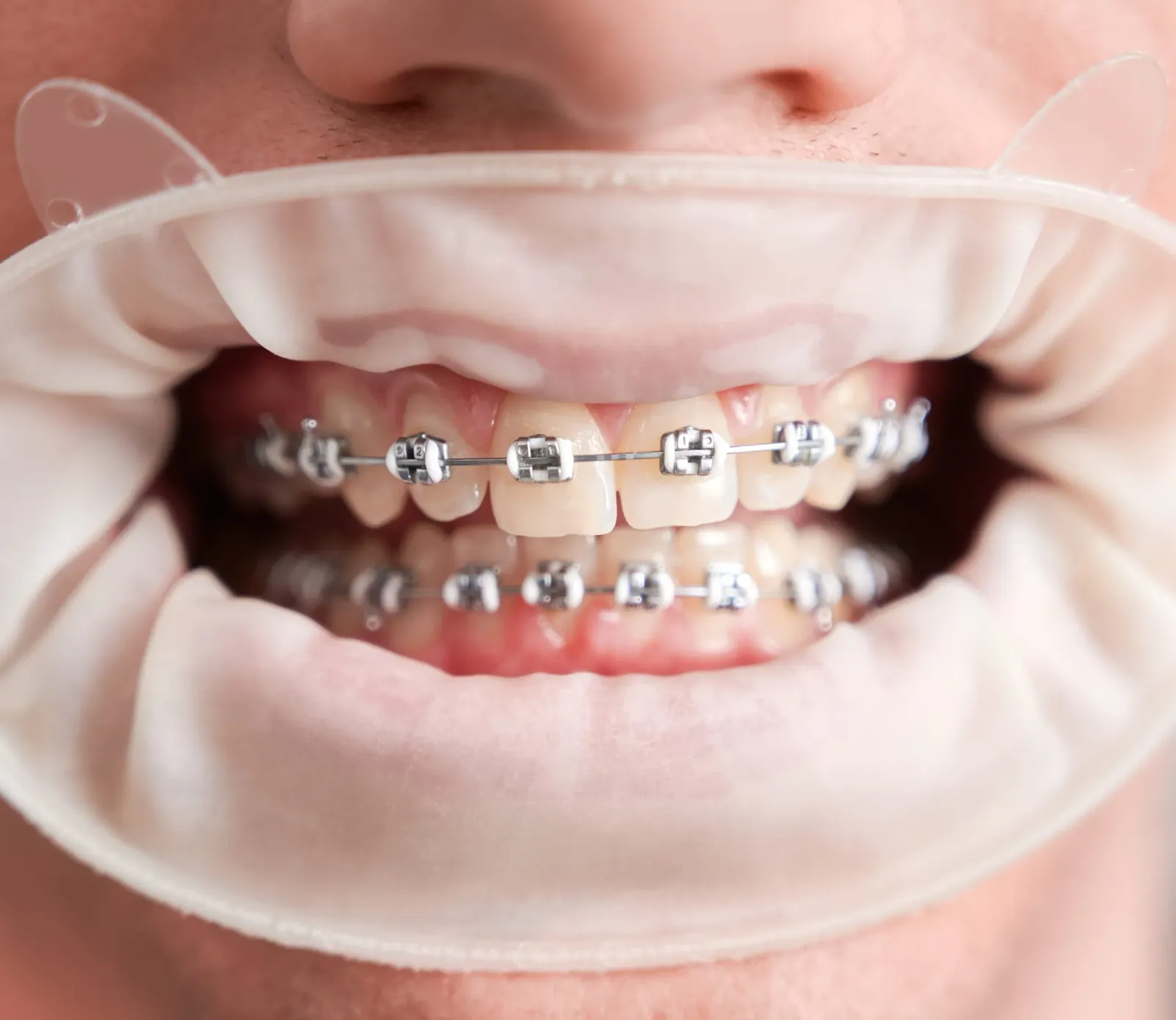 Traditional braces on teeth
