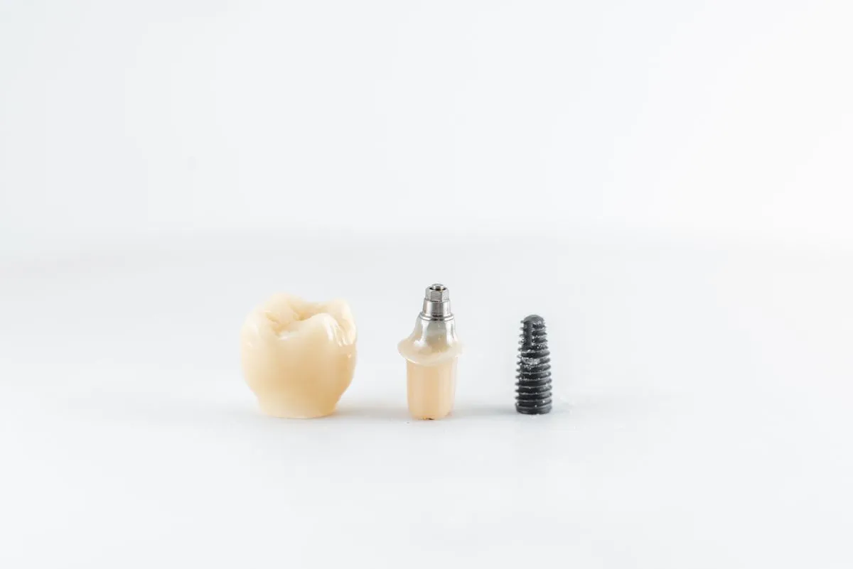 Dental implant model showing titanium post and crown restoration