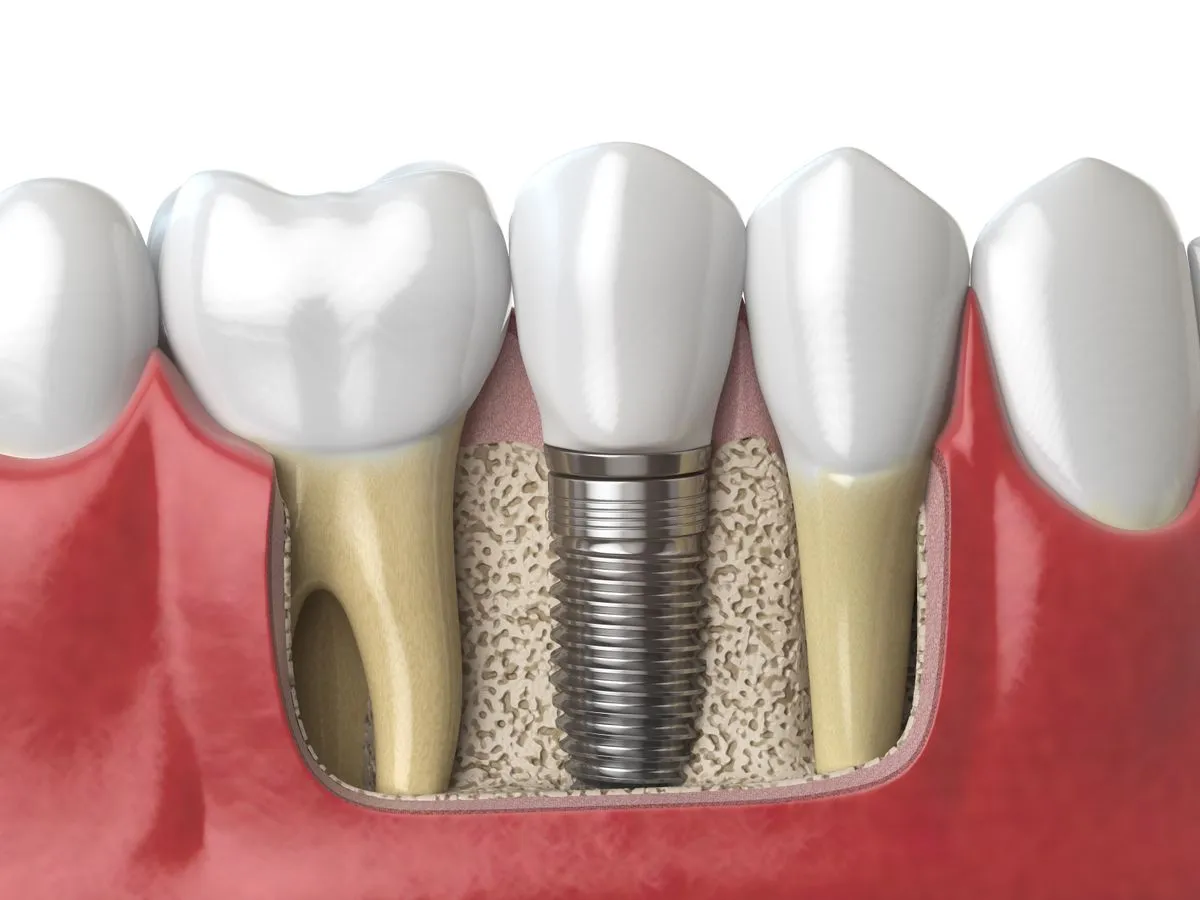 Dental care for Fountain Valley, CA patients