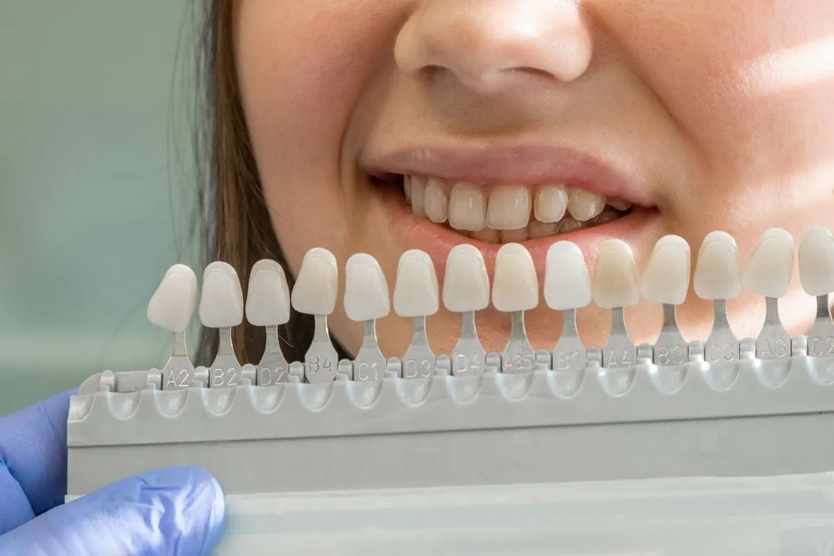 Cosmetic veneers aligned on front teeth