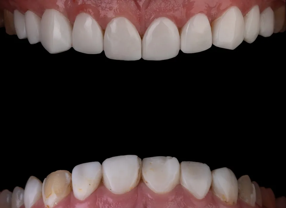 What Causes Cavities and How to Prevent Them