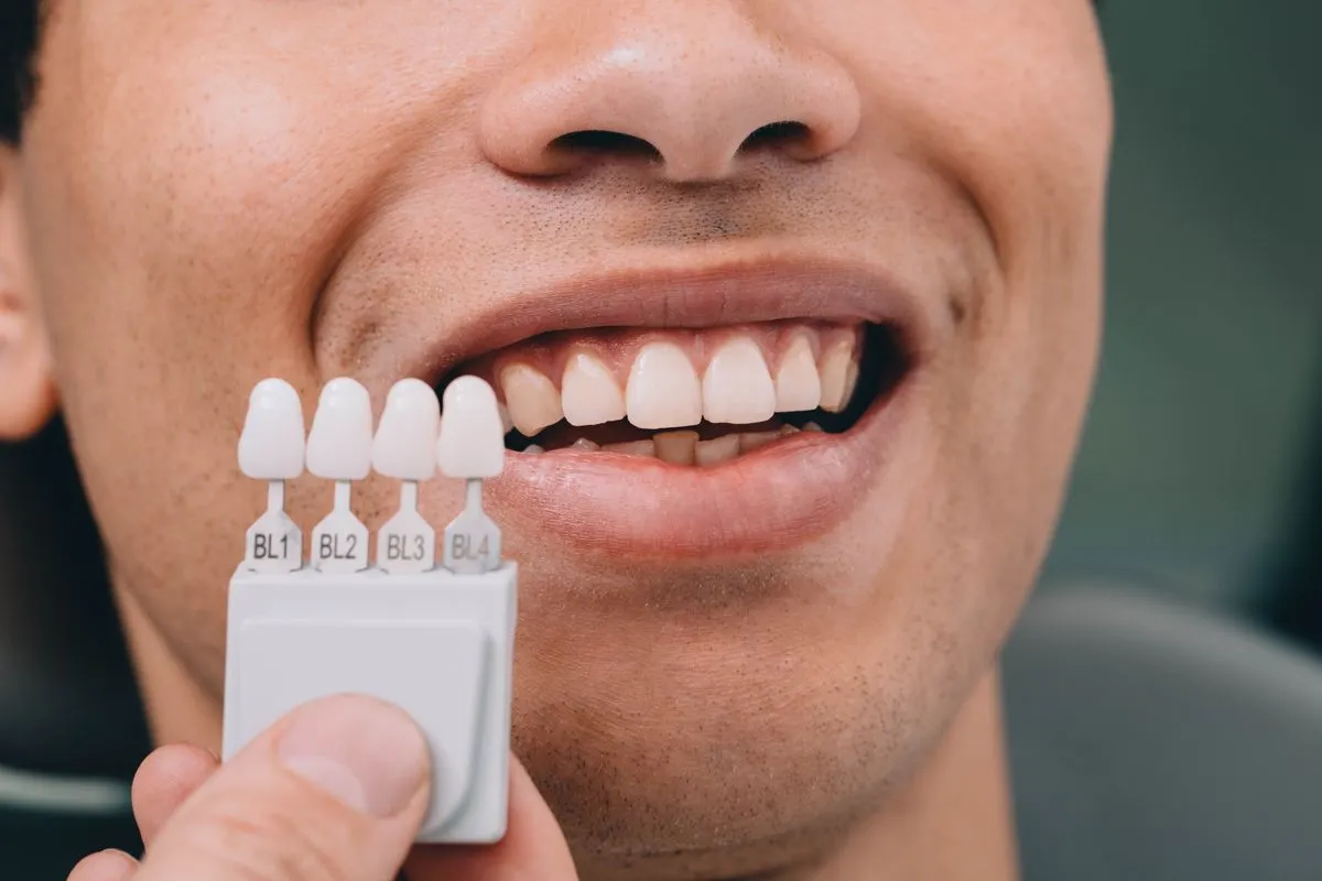 Dental veneers before and after results — Huntington Beach patient, Dr. Richard Baldwin DMD