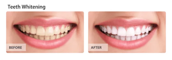 Teeth whitening before and after results — Huntington Beach patient, Dr. Richard Baldwin DMD