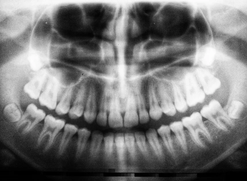 Wisdom Teeth Removal in Huntington Beach, CA