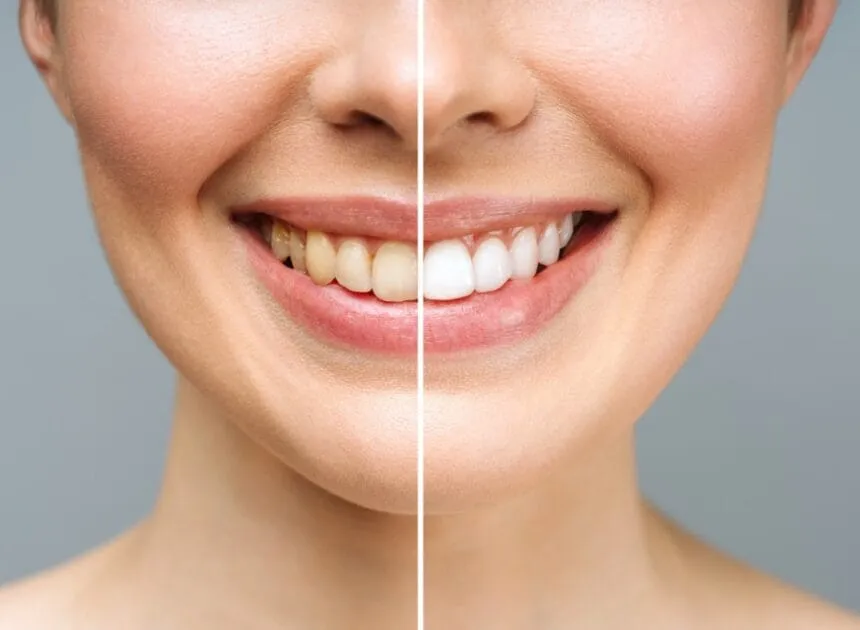 Teeth Whitening Cost in HB: Zoom vs Take-Home